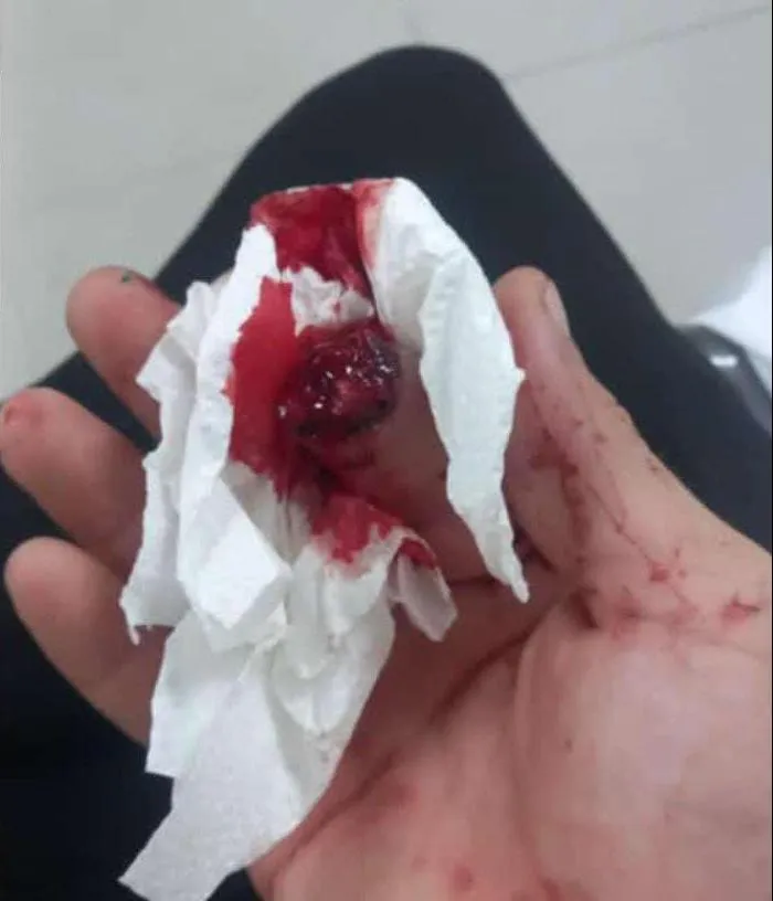 Un empleado municipal perdió un dedo mientras hacía su trabajo de recolección